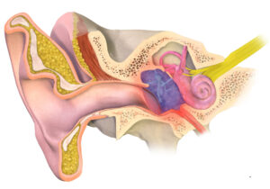 Schéma d'une oreille infectée lors d'une otite