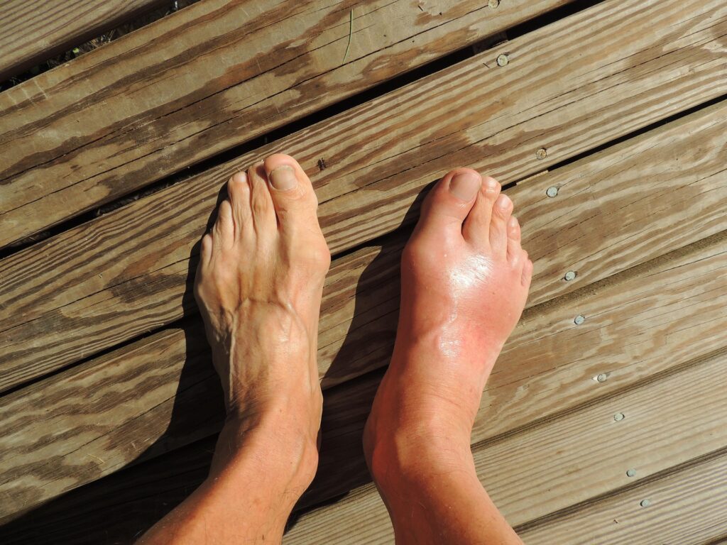 Magnétisme et fracture interne du pied.
