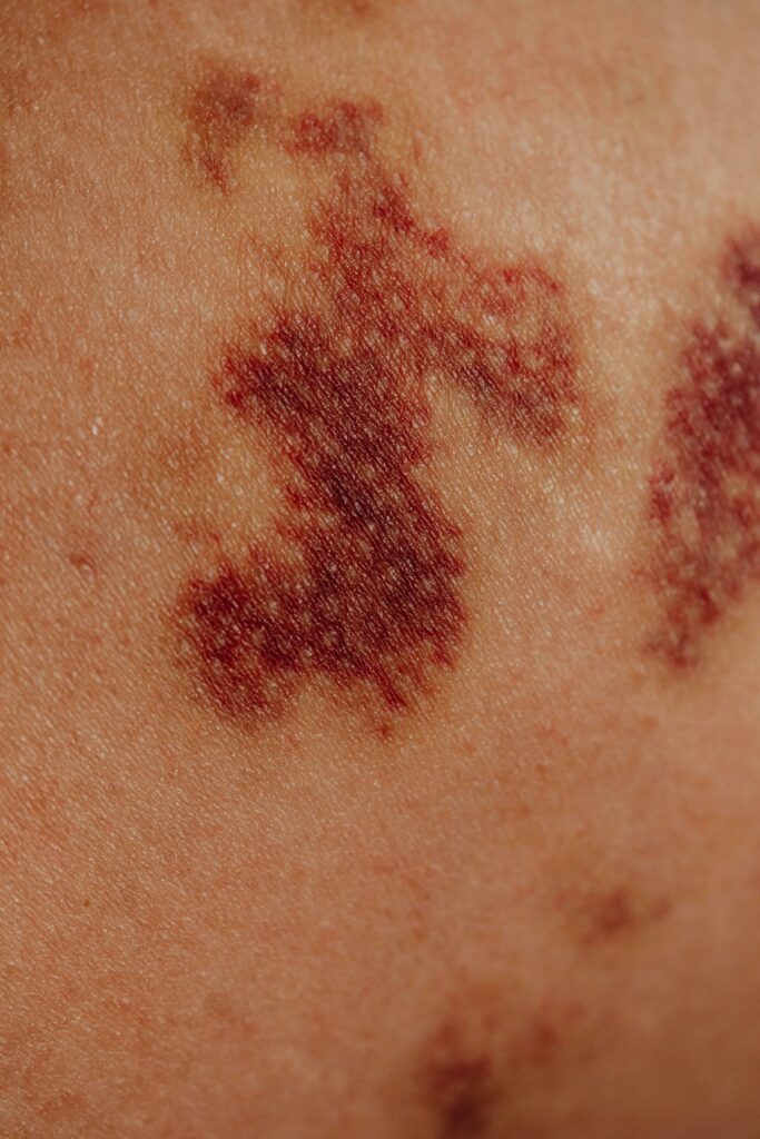 Magnétisme et inflammations cutanées (zona, pityriasis, brûlures, réactions alimentaires…) Magnétisme et inflammations cutanées (zona, pityriasis, brûlures, réactions alimentaires…)